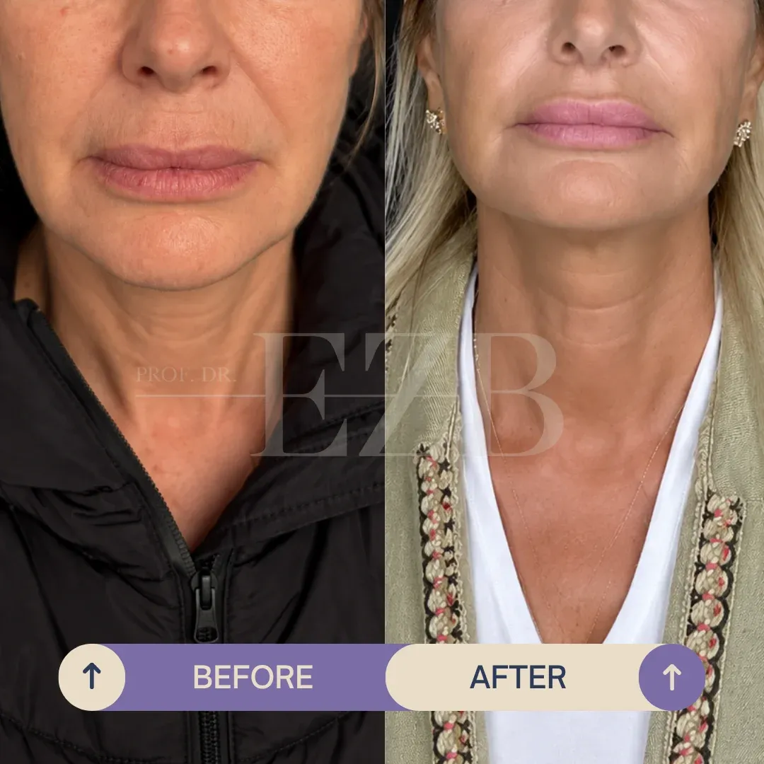 Lip Lift, before and after