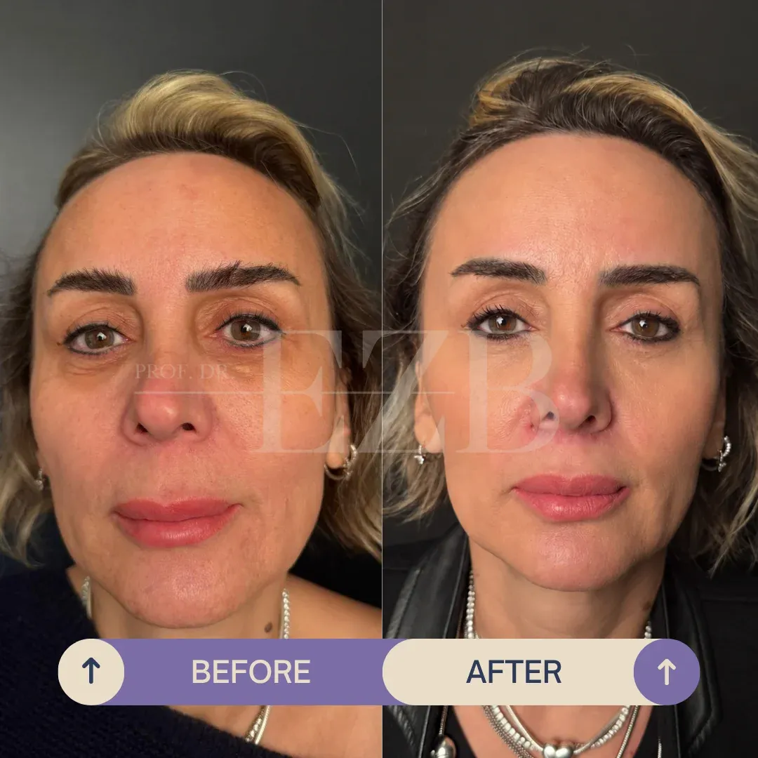 Lip Lift, before and after