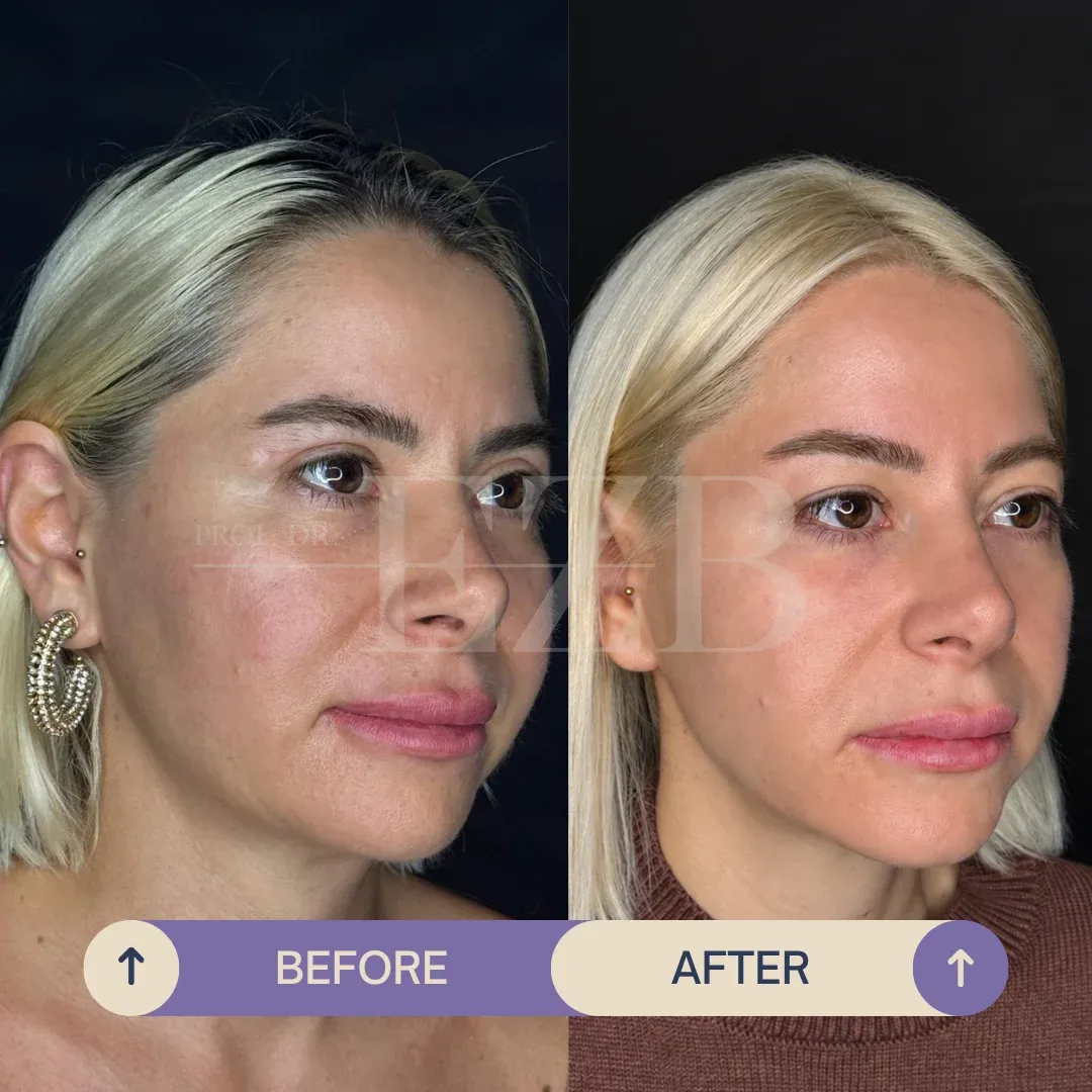 Upper Eyelid Blepharoplasty, before and after