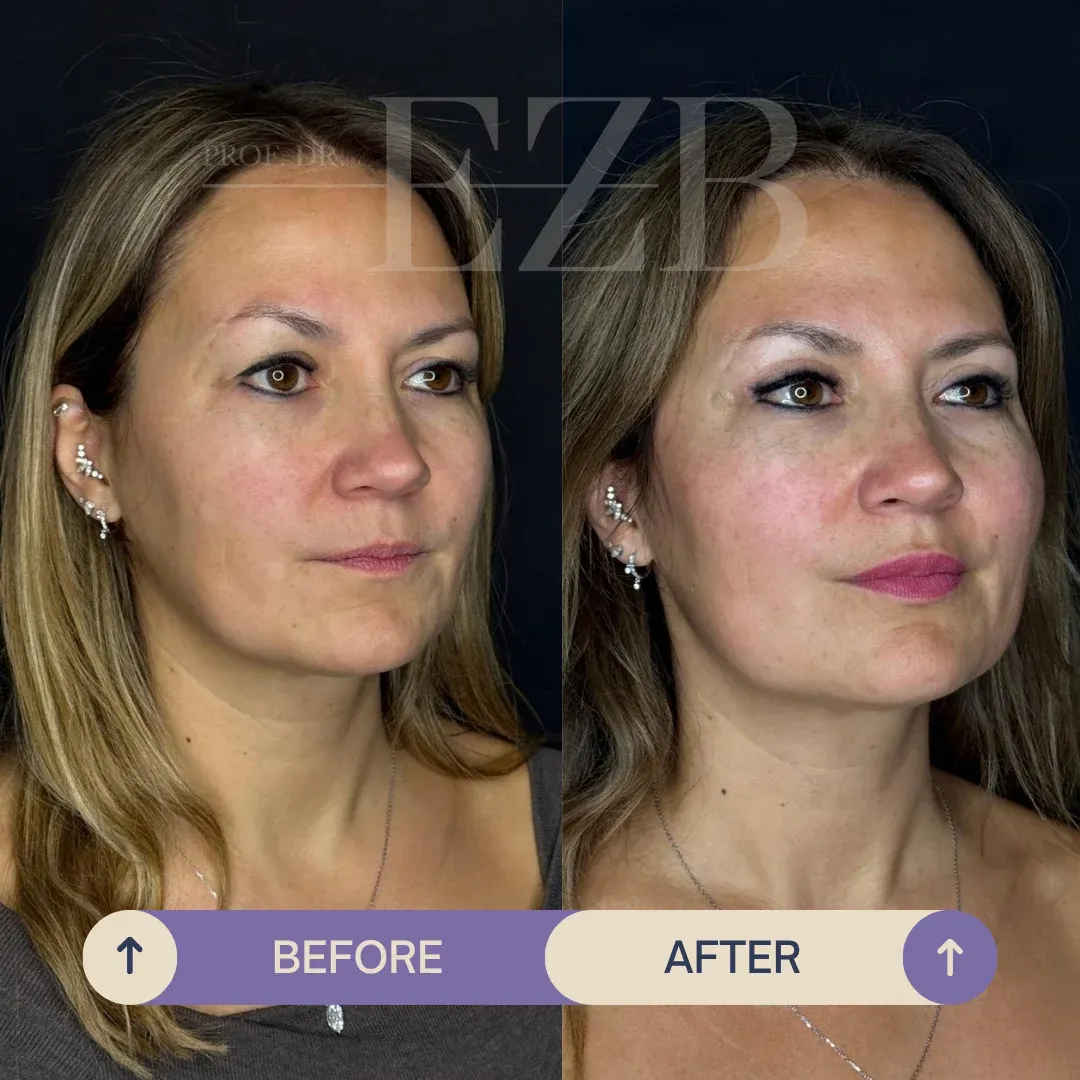 Upper Eyelid Blepharoplasty + Mini Face Lift, before and after